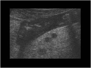 Thickened bowel wall and inflamed perienteric fat