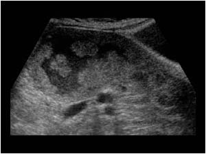 Irregular thickened endometrium with polypoid lesions longitudinal