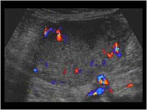 Irregular thickened endometrium with vascularized polypoid lesions transverse