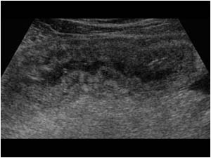 Bowel wall thickening and ascites