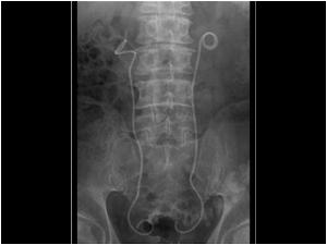 Plain abdominal X ray showing a stent in the right and left ureter.

The above images present the typical characteristics off a case of retroperitoneal fibrosis. Retroperitoneal fibrosis often presents with a dilatation of the renal collecting system ca