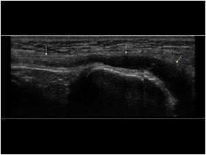 Longitudinal image of the same lesion. The structure is in relation with the peroneal nerve (proximal arrow).