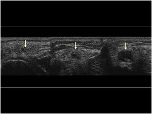 Three transverse images of the peroneal nerve from proximal to distal showing the close relation between the cystic lesion and the peroneal nerve.