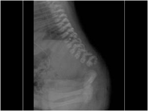Lateral X ray of the lumbar spine showing an abnormal development of the lower lumbar spine and sacral bones.