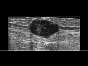 Longitudinal image of the mass in continuation with the greater saphenous vein. The mass is hypoechoic but solid, has a slightly lobulated aspect, smooth margins and shows no signs of infiltration.