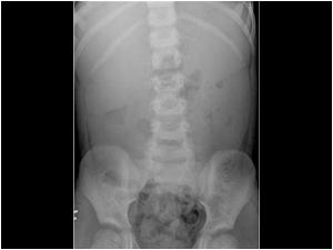 Plain abdominal film showing the enlarged kidneys.