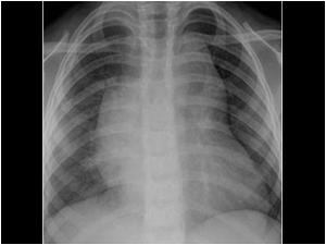 Chest X ray of the same child showing a widened mediastinum caused by enlarged lymphe nodes.