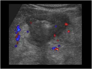 Thickening of the bowel wall transverse