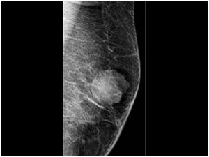 Mammography of the lesion shows a mainly well defined lesion with a slightly lobulated irregular anterior aspect.

We decided to do an ultrasound guided puncture. The lesion proved to be mainly cystic with hemorrhagic fluid. After aspiration no mass was