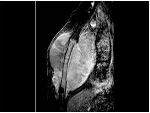 MRI of the mass shows not only the extension of the tumor on the anterior aspect but also dorsal of the sternum. There is an abnormal signal intensity of the sternum.