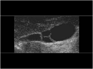 Longitudinal image of the gallbladder with multiple septations