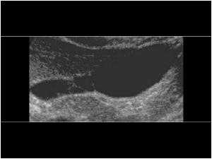 Longitudinal image of the same multiseptated gallbladder with thin septations