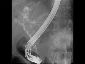An ERCP and papillotomy confirmed the diagnosis in this case