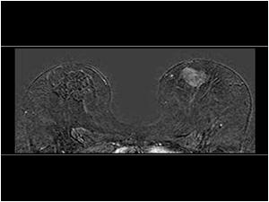 A contrast enhanced MRI scan shows early uptake of contrast in an area in the left breast