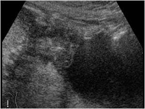 Sigmoid carcinoma growing in the bladder