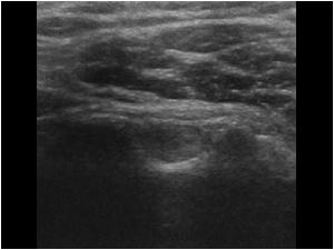 Absent tendon in the bicipital groove transverse
