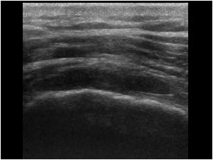 Absent tendon in the bicipital groove longitudinal
