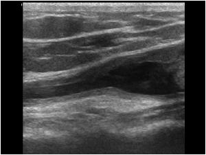 Absent tendon in the bicipital groove longitudinal
