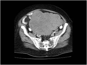Gastrointestinal stromal tumor CT