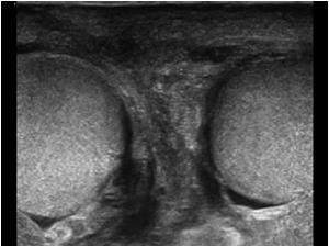 Transverse image of both normal testicles