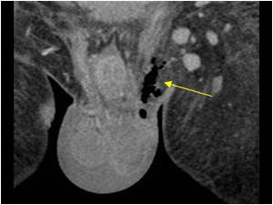 Coronal CT scan image of the scrotal wall showing air in the wall