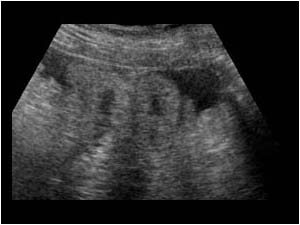 Bowel wall thickening and ascites