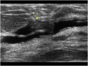 intraductal papilloma radiology ultrasound