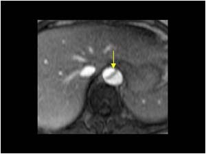 Aortic dissection transverse MRI