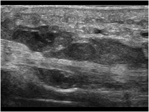 Deep flexor tendon surrounded by a hematoma longitudinal
