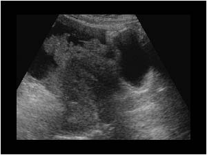 Irregular mass around a normal uterus and ascites longitudinal