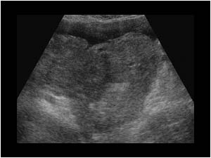 Irregular mass around a normal uterus transverse
