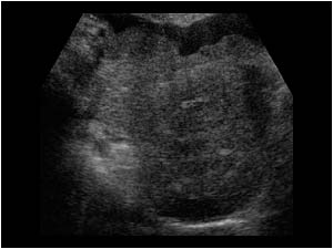 Irregular mass around a normal uterus transverse