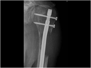 Metastasis (of a spindle cell tumor) in the humerus with surgical fixation