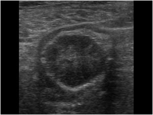 Transverse image of the mass showing its position within the descending colon