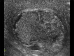 Neonatal testicular torsion with swollen inhomogeneous nonvasculaized testis and peritesticular vascularity