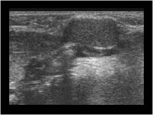 Small ranula cyst medial of the submandibular gland