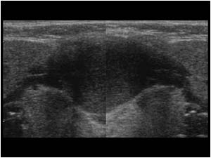 Ranula cyst in the midline transverse