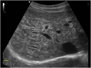 Transverse image of the liver with a diffuse inhomogeneous structure
