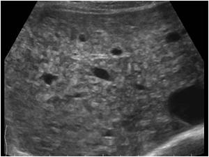 Transverse image of the liver at a different level showing again the diffuse inhomogeneous structure