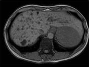 T1 MRI of the same liver. The lesions have a low signal intensity compared to the liver parechyma
