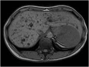 T1 MRI of the same liver at another level. The lesions have a low signal intensity compared to the liver parechyma