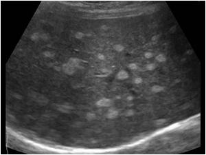 Transverse image of the liver. The liver has multiple small hyperechoic lesions