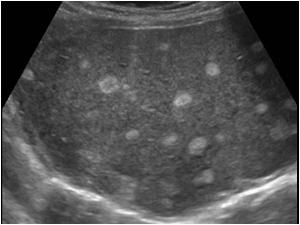 Another image of the same liver with multiple hyperechoic lesions