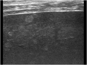 The following images also show incidentally found hyperechoic lesions in a 47 year old female