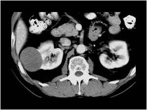 Complex renal cysts