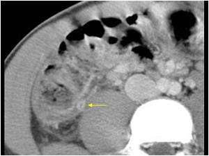 CT scan of the same patient shows a normal appendix in a retrocecal position