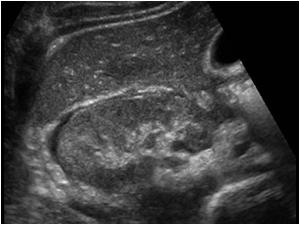 Transverse image of the right kidney with perirenal effusion
