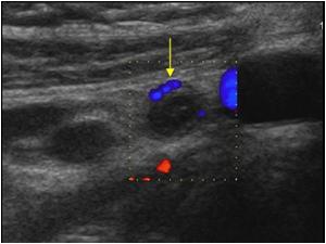 Transverse image of the tip with color doppler. The diameter is nearly 6 mm. which is within normal limits