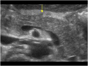Transverse image of the pancreas. There is a minimal contour irregularity of the anterior aspect of the pancreas