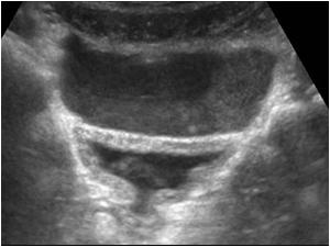 Transverse image through the lower abdomen shows some blood around the bladder